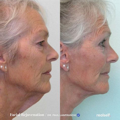 Discover cost, reviews, photos, and more to help you research neck lift surgery. Neck Lift Before And After, Sagging Neck Skin, Body Lift Surgery, Neck Lift Surgery, Face Procedures, Facelift Surgery, Facelift Before And After, Saggy Neck, Facial Procedure