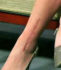 Seattle Plastic Surgeon discusses the importance of keeping fresh scars out of the sun. This ankle scar would have turned out much better had it been protected from the sun! Leg Scars, Broken Ankle, Leg Injury, Shoulder Surgery, Going To Rain, David Letterman, The Big Bang Theory, Kaley Cuoco, Steel Bar