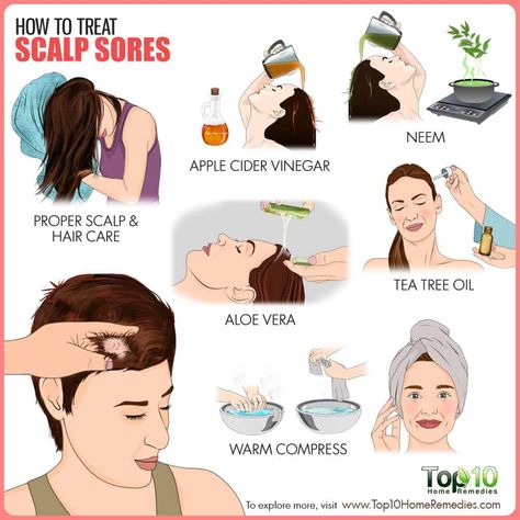 How to treat scalp sores Sores On Scalp Remedies, Sore Scalp Remedies, Healthy Scalp Treatments, Scalp Excema, Itchy Scalp Remedy Diy, Scabs On Scalp, Hair Problems Remedies, Scalp Sores, Itchy Scalp Remedy