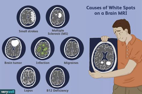 Spots on an MRI: White Matter Hyperintensities White Matter In Brain, Brain Mri, Mri Brain, Angina Pectoris, Frontal Lobe, Peripheral Nerve, Multiple Sclerosis Awareness, White Matter, Brain Scan