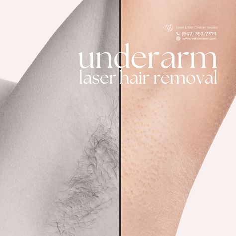 Laser Away Underarm Hair 🪒  Experience the ease of underarm care with our laser hair removal treatments! 🌟 Say farewell to razors and wax strips and hello to lasting smoothness.  🔹 Swift sessions 🔹 Long-term results 🔹 Comfortable experience 🔹 Reduced ingrown hairs  Lift your arms with confidence every day!   Book now:⁣ 💚 VS MedSpa Laser & Skin Clinic in Toronto:⁣  🌎https://www.versuslaser.com/ ⁣ Laser Hair Removal Sideburns, Laser Hair Removal Underarms, Laser Hair Removal Benefits, Laser Hair Removal Post Ideas, Laser Hair Removal Instagram Post, Laser Hair Removal Marketing Ideas, Laser Hair Removal Post, Laser Hair Removal Aesthetic, Laser Hair Removal Facts