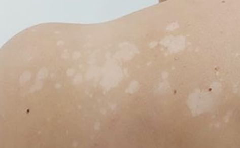 White Skin Patches, White Skin Spots, Skin Spots, White Patches, White Skin, Health Science, Dark Spots, Good Skin, Design Inspo