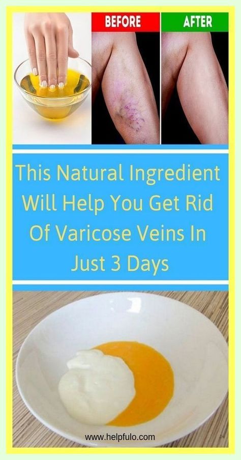 This Natural Ingredient Will Help You Get Rid Of Varicose Veins In Just 3 Days ! Home Remedies For Spiders, Varicose Vein Remedy, Tandoori Masala, Natural Healing Remedies, Stubborn Belly Fat, Health Remedies, Natural Healing, Grow Business, Home Remedies