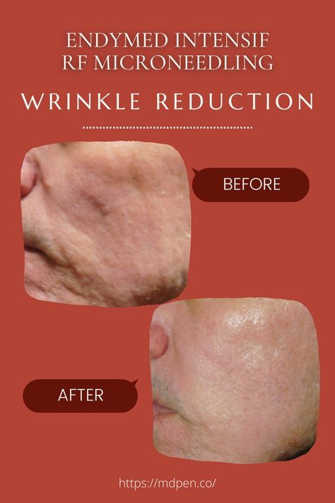 EndyMed Intensif - Wrinkle Reduction Amazingly beautiful results just after 5 Endymed Intensif RF Microneedling! 😍💖 💌 Contact us at 888-313-1415 or click to schedule a call at your convenience to learn more about EndyMed or MDPen devices, treatments and skincare. #mdpen #microneedling #beforeandafter #beautifulresults Rf Microneedling, Beauty Self Care, Wrinkle Reduction, My Vibe, Anti Aging, Self Care, To Learn, Contact Us, Beauty