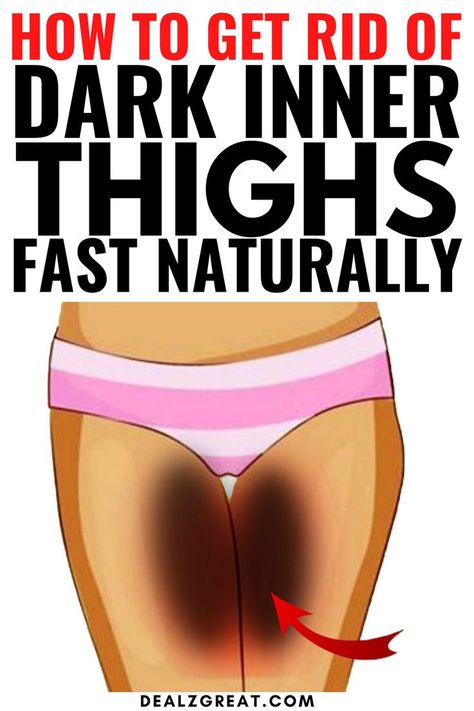 10 Best Home Remedies to Get Rid Of Dark Inner Thighs Fast! Pigmentation Remedy, Dark Inner Thighs, Dark Spots Remedies, Blind Pimple, Pimples Under The Skin, Dark Spots On Skin, Lighten Dark Spots, Daily Health Tips, Skin Remedies