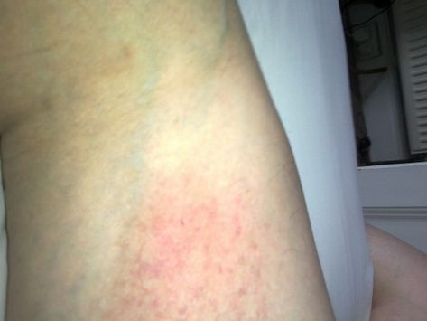 This was the kind of rash I first go before being diagnosed. Autoimmune Rash Pictures, Autoimmune Disease Symptoms, Autoimmune Disorders, Itchy Rash, Autoimmune Diet, Sjogrens Syndrome, Heat Rash, Ear Health, Disease Symptoms