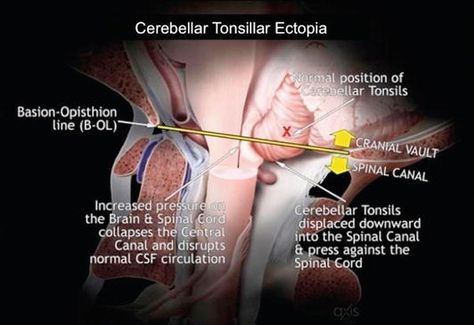 Csf Flow, Best Exercise For Hips, Vascular System, Vertebral Artery, Glial Cells, Cervical Pain, Spinal Fluid, Ligament Tear, Chiari Malformation