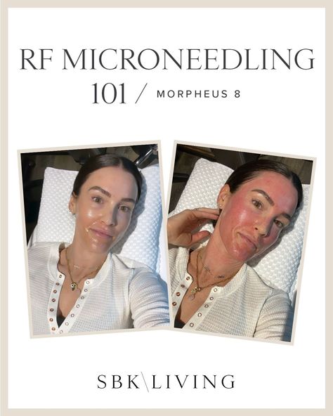 After listening to numerous hours of podcasts with dermatologists and skincare professionals, I knew RF microneedling was in my future. I'm sharing all the details and answering all the questions for skincare. | SBK Living Microneedling With Radio Frequency, Rf Microneedling Before And After, Micro Needling Before And After, Microneedling Before And After, At Home Microneedling, Microneedling At Home, After Microneedling, Rf Microneedling, Entry Styling