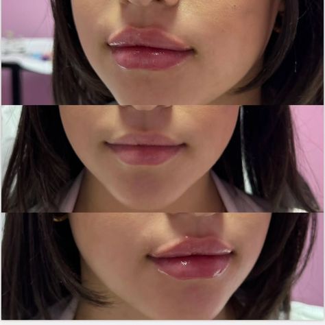 Another beautiful job for our patient. Ask us about our Special $299 lip filler summer special and $8.99 Botox and $3.75 Dysport Full face liquid face lift special $1,899 Join our club for $99 per year membership and enjoy even better exclusive pricing for the whole year! Book your Free consultation appointment at www.vipaestheticcenter.com or call us at 954.903.4043 #lipinjections #lipfillerbeforeandafter #lipflip #revanesselips #restylanekysse #restylane #juverderm #juvedermlip... Lip Filler Before And After Juvederm, 1ml Lip Filler Before And After, Lip Filler Styles, Lip Filler Shape Ideas, Lip Filler Inspiration, 1ml Lip Filler, Juvederm Lips, Chin Filler, Lip Lift