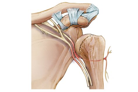 Axillary Nerve Palsy and Shoulder Dislocation | Bangalore Shoulder Institute Humerus Fracture, Subscapularis Muscle, Arm Numbness, Trapped Nerve, Nerve Injury, Axillary Nerve, Shoulder Dislocation, Sensory Nerves, Bone Fracture