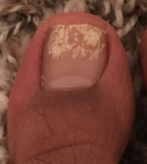 Help! I took off my nail polish and now I think I have a fungus! | Dr. Shyla Arya at Foot and Ankle Associates of North Texas #fungus #toenailfungus White Patches On Toenails, White Spots On Toenails, White Spots On Nails, Ugly Toenails, Nail Discoloration, Nail Remedies, Toenail Fungus Remedies, Nail Problems, Nail Fungus Remedy