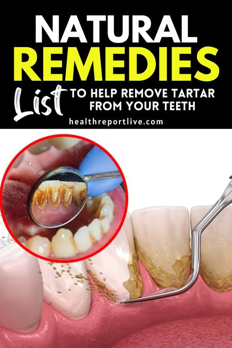 Natural Remedies List to Help Remove Tartar from your Teeth Get Rid Of Tartar On Teeth, How To Remove Plaque From Teeth, How To Get Rid Of Tartar Build Up, Tartar Build Up On Teeth, Get Rid Of Plaque On Teeth, Brushing Teeth With Baking Soda, How To Get Rid Of Tartar On Teeth, Stained Teeth How To Get Rid Of, Baking Soda And Peroxide Teeth