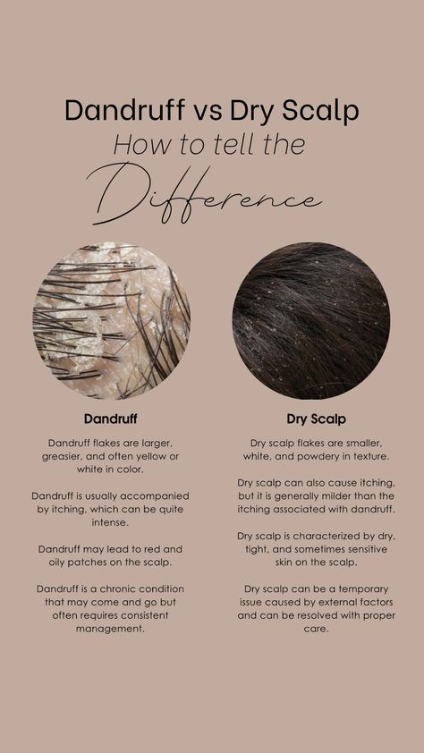 They may look similar – white flakes in your hair and on your clothing – but the difference between dandruff and dry scalp is real. There’s more to managing these common scalp conditions than simply using a dandruff shampoo. Scalp Spa, Dandruff Solutions, Home Remedies For Dandruff, Dandruff Flakes, Shampoo For Dry Scalp, Head Spa, Dandruff Remedy, Hair Dandruff, Scalp Scrub