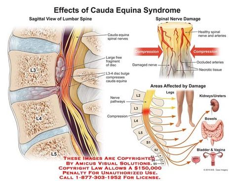 Cauda Equina Syndrome Human Body Muscles, Spinal Fusion Surgery, Cauda Equina, Cervical Spondylosis, Spinal Fusion, Spinal Surgery, Spinal Nerve, Peripheral Nerve, Degenerative Disease