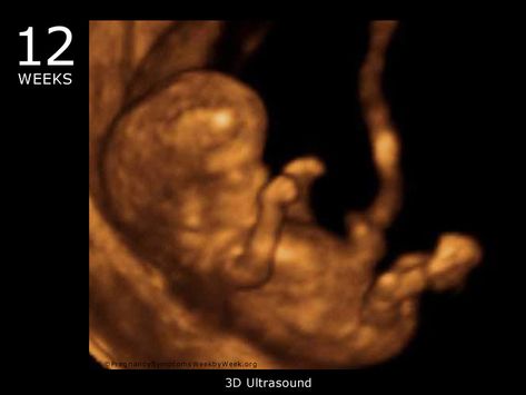 12 Week Ultrasound Pictures, 12 Weeks Pregnant Ultrasound, 12 Week Ultrasound, Pregnant Ultrasound, 11 Weeks Pregnant, 12 Weeks Pregnant, 3d Ultrasound, Pregnancy Ultrasound, Preterm Labor