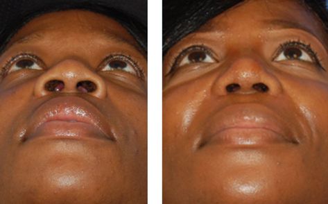 Nostril Surgery, Nostril Reduction, Nose Jobs, Reduction Surgery, Facial Plastic Surgery, Facial Plastic, Nose Job, Post Surgery, Self Image