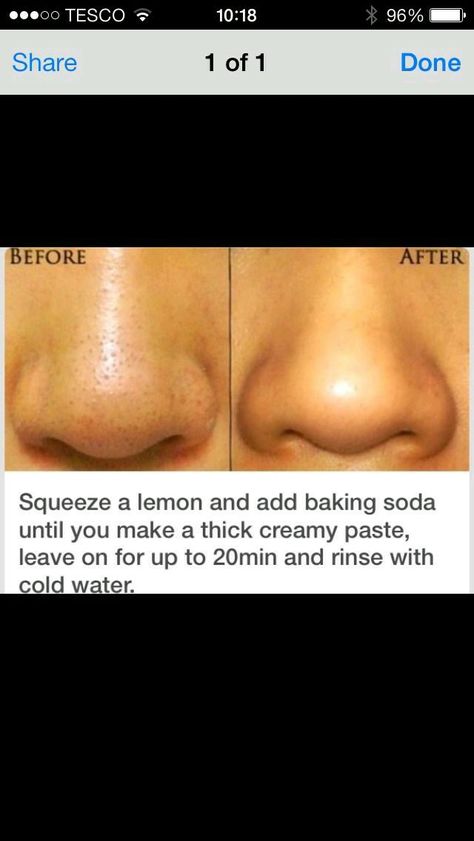 Get Rid Of Pores, Obličejové Masky, Skin Moles, Black Heads, Baking Soda Shampoo, Get Rid Of Blackheads, Skin Pores, Clogged Pores, Face Skin Care