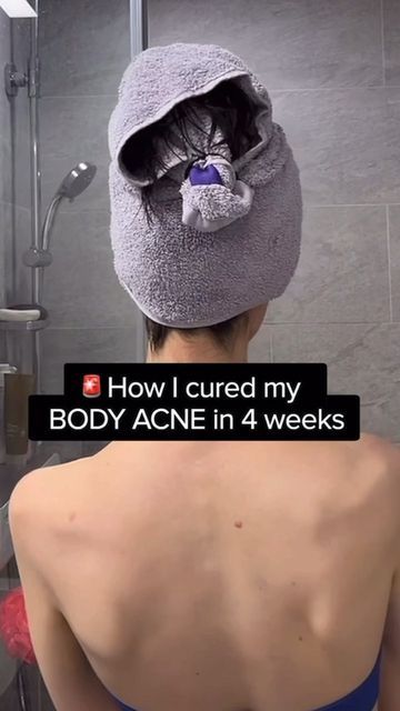 How To Get Rid Of Body Acne Fast, Nose Acne Cause, How To Treat Body Acne, Products For Back Acne, How To Clear Chest Acne, Backne Remedies Products, Backne Skin Care, How To Treat Back Acne, Backne Remedies Fast