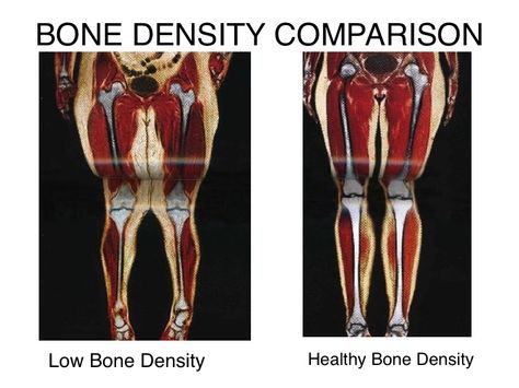 Density Comparison of Low bone mass with the #healthy #bone #mass Ossification Of Bones, Building Bone Density, How To Improve Bone Density, Bone Mineral Density Test, Structure Of Bone, Low Bone Density, Bone Density, Healthy Bones, Density