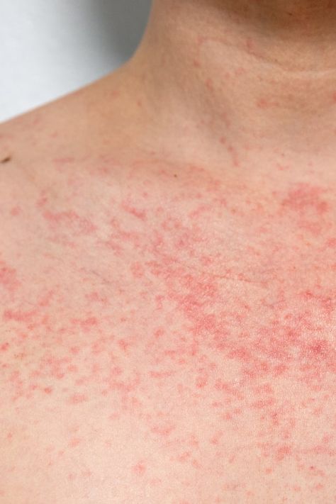 How To Get Rid Of Heat Rash, Heat Rash Remedy For Adults, Skin Rash On Face, Heat Rash Remedy, Prickly Heat Rash, Itchy Skin Rash, Rash On Face, Rashes Remedies, Rash Causes