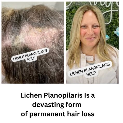 Lichens Sclerosis, Lichen Planopilaris, Moss And Lichen, Types Of Lichen, Lichen On Trees, Hair System, Hair Follicle, Skin Conditions, Hair Growth