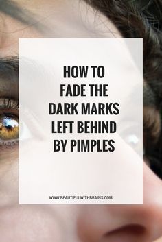 How to fade away and prevent post-inflammatory hyperpigmentation, the dark marks left behind by pimples and other types of inflammation. #pimples #acne #darkspots Blind Pimple, Pimples Under The Skin, How To Fade, Post Inflammatory Hyperpigmentation, Pimples Remedies, How To Get Rid Of Pimples, Dark Spots On Skin, Pimple Marks, Peeling Skin