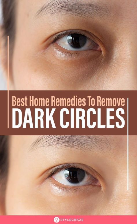 27 Best Home Remedies To Remove Dark Circles Under Eyes Permanently: If you too are one of the many individuals tormented by dark circles, worry not, there are several home remedies for dark circles. These simple and easy-to-do solutions will not only lighten your dark circles but also nourish and hydrate the skin under and around your eyes. #Beauty #BeautyTips #Remedies Remedies For Dark Circles, Dark Circle Remedies, Dark Circles Around Eyes, Dark Eye Circles, Remove Dark Circles, Under Eyes, Dark Circles Under Eyes, Dark Circle, Eye Circles