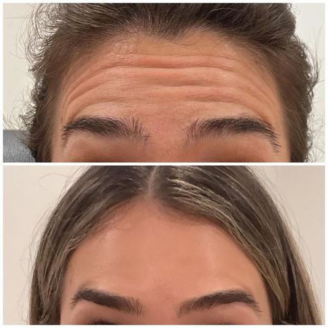 Face Injections, Botox Forehead, Botox Before And After, Face Lift Surgery, Botox Cosmetic, Botox Face, Esthetician Marketing, 20 Year Anniversary, Forehead Wrinkles