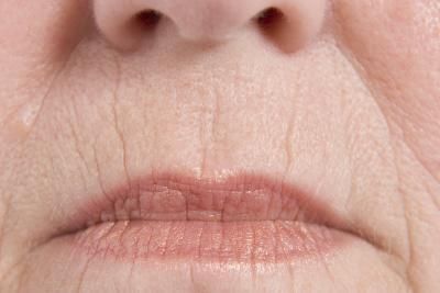 Home Remedies to Plump the Wrinkles on the Face Lines Around Mouth, Upper Lip Wrinkles, Chapped Lips Remedy, Smokers Lines, Mouth Wrinkles, Wrinkle Remedies, Plastic Surgery Procedures, Eliminate Wrinkles, Lip Wrinkles