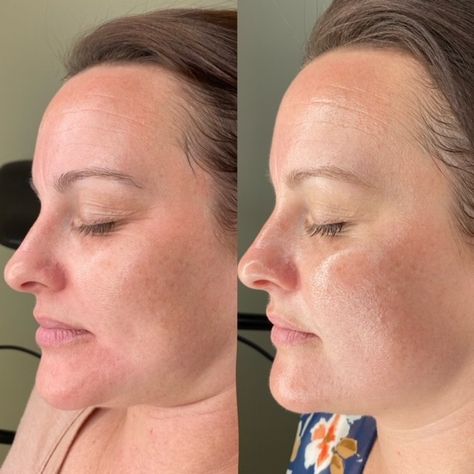 Biorepeel Before And After, Wrinkles Before And After, Retinol Results, Skin Care Before And After, Retinol Before And After, Chemical Peel Before And After, Chemical Peel Results, Facial Before And After, Vi Peel