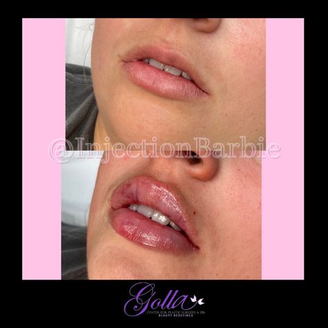 Lip Flip Inspiration, Lip Flip Aesthetic, Before And After Lip Flip, Lipfiller Before After, Lip Flip And Filler, Lip Flip Before And After, Lip Flip Botox Before And After, Beauty Surgery, 2023 Affirmations