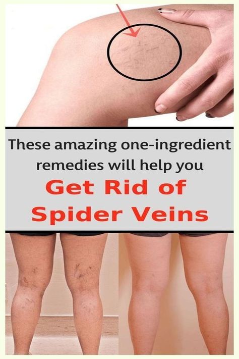 MY GRANDMOTHER TAUGHT ME THIS REMEDY TO ELIMINATE VARICOSE OR SPIDER VEINS. NOW MY LEGS LOOK AMAZING! Spider Vein Remedies, Spider Vein Removal, Varicose Vein Remedy, Get Rid Of Spiders, Vein Removal, Natural Healing Remedies, Diy Remedies, Natural Therapy, Natural Home Remedies