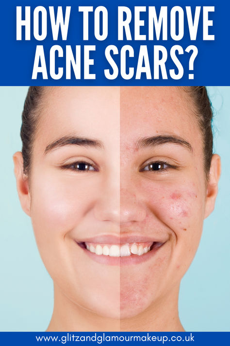 Discover effective strategies for removing acne scars! Explore treatments, home remedies, and skincare tips that can help you achieve smoother, clearer skin. Acne Scar Removal Cream, Acne Scar Remedies, Scar Remedies, Face Mapping Acne, Scar Removal Cream, Acne Makeup, Oily Skin Acne, Acne Scar, Dark Spots On Skin