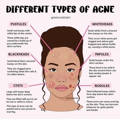 Different Types Of Acne, Face Mapping Acne, Skin Facts, Skin Advice, Esthetician Room, Skin Aesthetics, Clear Healthy Skin, Types Of Acne, Basic Skin Care Routine