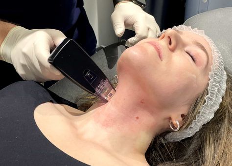 I Tried Morpheus8—and It Didn’t Hurt at All. Here’s Why. Tummy Tucks Recovery, Morpheus 8, Saggy Neck, Tech Neck, Numbing Cream, Facial Plastic, Tummy Tucks, Anti Aging Treatments, I Wish I Knew