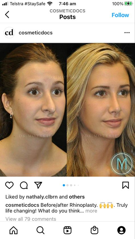 Nose Job Before And After Front View, Nose Tip Surgery Before After, Rhinoplasty Before After, Nose Job Before And After, Nonsurgical Nose Job, Beauty Job, Nose Jobs, Rhinoplasty Nose Jobs, Under Eye Fillers