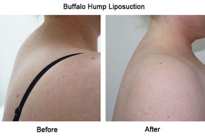 How To Get Rid Of A Buffalo Hump Dowager Hump, Neck Fat Exercises, Back Hump, Shoulder Range Of Motion, Dowager's Hump, Upper Back Exercises, Neck Hump, Forward Head Posture, Neck Exercises