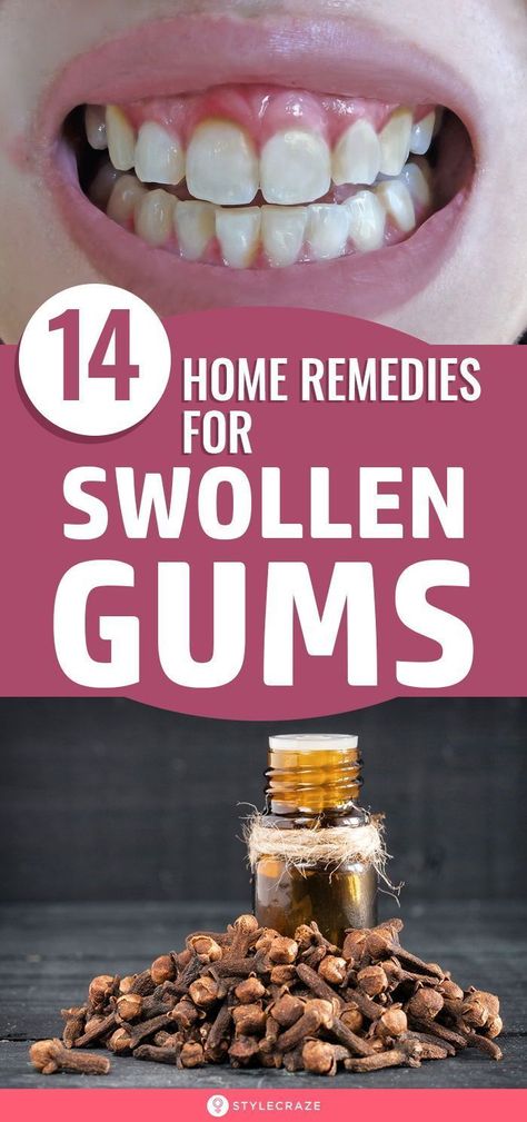 Swollen Gums Remedy, Swelling Remedies, Inflammation Remedies, Gum Inflammation, Remedies For Tooth Ache, Swollen Gum, Teeth Health, Gum Care, Receding Gums