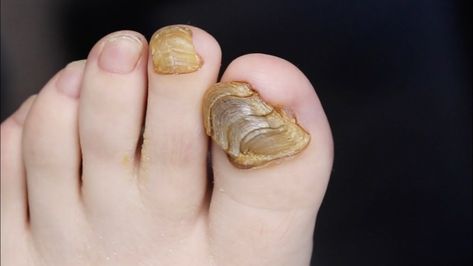 CRAZY TOENAIL SHELL?! SUPER THICK NAIL CLIPPING!!! #toebroclip Gross Toenails, Split Toenail, Curved Toenails, Ugly Toenails, Toenail Fungal Infection, Toenail Removal, Medical Videos, Ingrown Toe Nail, Toenail Fungus