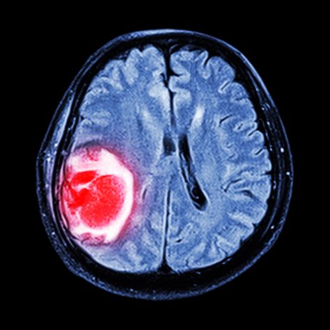 MRI combines with sound waves to reveal the stiffness of tumors Picture Of Body, Mri Brain, Fat Loss Program, Qi Gong, Body Tissues, Types Of Cancers, Radiology, Sound Waves, Blood Pressure