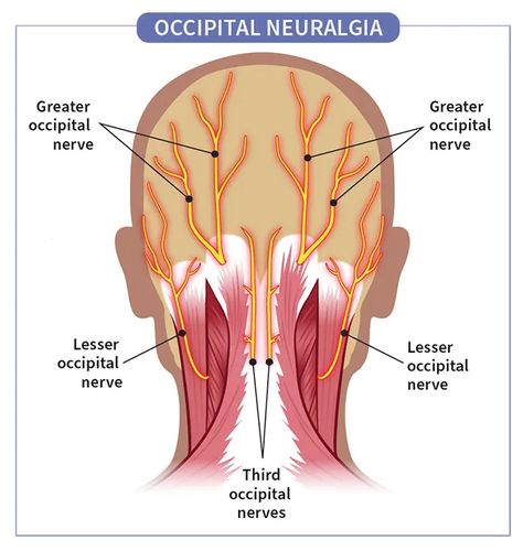 Occipital Neuralgia: Symptoms, Causes, Diagnosis, Treatments, and More Vestibular Migraines Symptoms, Occipital Neuralgia Symptoms, Trigeminal Neurology, Occipital Neuralgia Relief, Cervical Instability, Autoimmune Disease Symptoms, Occipital Neuralgia, Migraine Pain, Facial Nerve