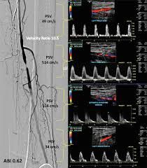 Edelman Ultrasound Physics, Ultrasound Spi Exam, Lower Extremity Arterial Ultrasound, Diagnostic Medical Sonography Student, Understanding Ultrasound Physics, Medical Sonography, Sonography Student, Vascular Ultrasound, Medical Ultrasound