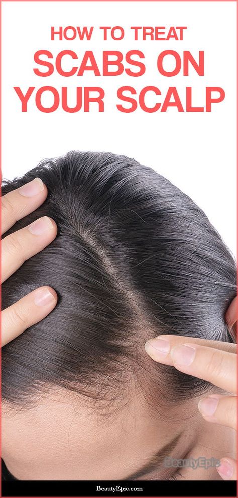 How to Get Rid of Scabs on Scalp – What it is, Causes and How to Treat Scabs On Scalp, Scalp Scabs, Scaly Scalp, Pimples On Scalp, Itchy Scalp Remedy, Sores On Scalp, Scalp Acne, Clean Scalp, Dry Itchy Scalp