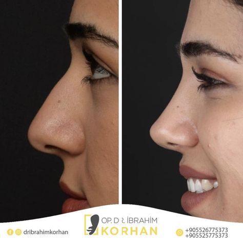 Iranian Nose Job Before And After, Nose Job Inspiration Rhinoplasty, Natural Nose Job Rhinoplasty, Nose Job Droopy Tip, Good Nose Jobs, Nose Jobs Inspiration, Natural Looking Nose Job, Cute Nose Job, Nose Inspo Rhinoplasty