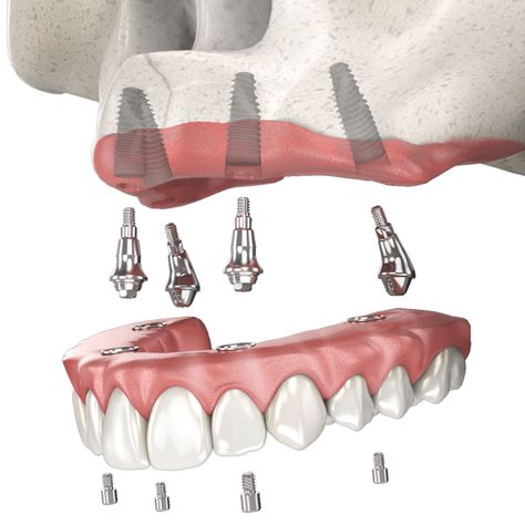 Implant supported dentures are a fantastic solution for individuals who have lost multiple teeth or require full-mouth tooth replacement. These dentures are designed to be more stable and secure than traditional removable dentures, as they are anchored into the jawbone using dental implants.

Dupont☎️ (260) 490-2013
Jefferson☎️ (260) 459-2860
Columbia City☎️ (260) 245-3161
#DrLuga #FortWayne #OralSurgeon #TheImplantDoctor #ImplantSupportedDentures Dental Images, Denture Implants, Oral Maxillofacial, Jaw Surgery, Dental Implants Cost, Dental Fun, Columbia City, Oral Surgeon, Tooth Replacement