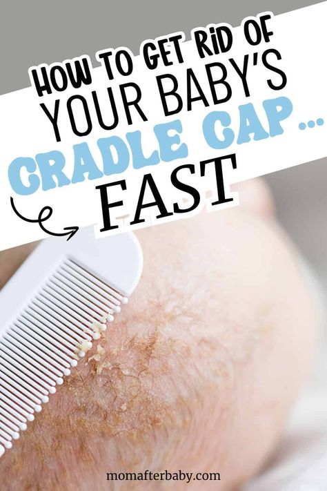 Best Remedies to Get Rid of Cradle Cap Baby Acne Remedy How To Get Rid Of, How To Get Rid Of Cradle Cap, Baby Acne Remedy, Cradle Cap Remedies, Baby Cradle Cap, Baby Dry Skin, Dry Scaly Skin, Baby Poop, Baby Sleep Routine