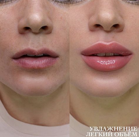 Lip Fuller Shapes, M Shaped Lips Before And After, M Shape Lips, M Shape Lip Filler, Small Mouth Lip Fillers, Lip Filler Shape Ideas Russian, Lip Filler Inspiration Natural, Desired Lips, Get Fuller Lips Naturally