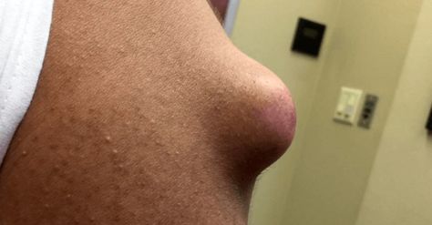 cool Girl Gets Massive ‘Doorknob’ Arm Cyst Popped And It’s Too Gross For Words Check more at http://viralleaks.us/2016/10/28/girl-gets-massive-doorknob-arm-cyst-popped-and-its-too-gross-for-words/ Cystic Pimple, Baby Acne, Hard Boiled, Hard Boiled Eggs, Better Skin, Door Knob, Simple Skincare, Door Knobs, Trending Topics