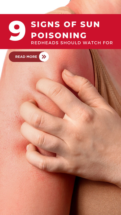 Sun poisoning can be avoided, so it’s important to know what signs/symptoms to look for, how to prevent it, and how to treat it. Sun Poisoning, Summer Tips, Signs And Symptoms, Redheads, Read More, To Look, Sun, Signs, Reading