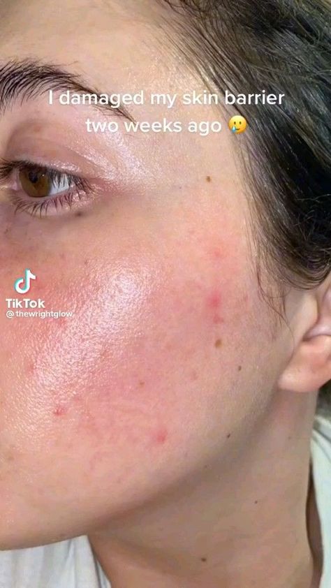 #How_To_Fix_Skin_Texture #Healthy_Skin_Barrier #How_To_Fix_Skin_Barrier #How_To_Fix_Dry_Skin How To Know If Your Skin Barrier Is Damaged, How To Fix Skin Barrier, Healthy Skin Barrier, How To Fix Skin Texture, How To Restore Skin Barrier, How To Fix Acne, How To Fix Dry Skin, Repair Skin Barrier Products, Restore Skin Barrier